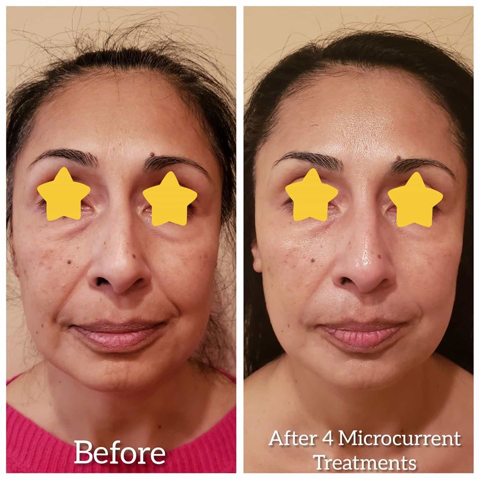 Microcurrent Facial Treatment Before And After Pics Nj